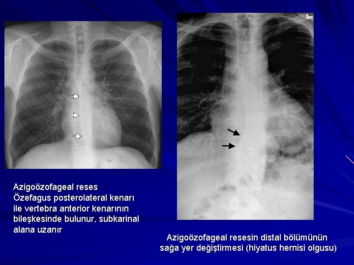 Azigoözofageal reses Özefagus posterolateral kenarı ile vertebra anterior kenarının bileşkesinde bulunur, subkarinal alana uzanır