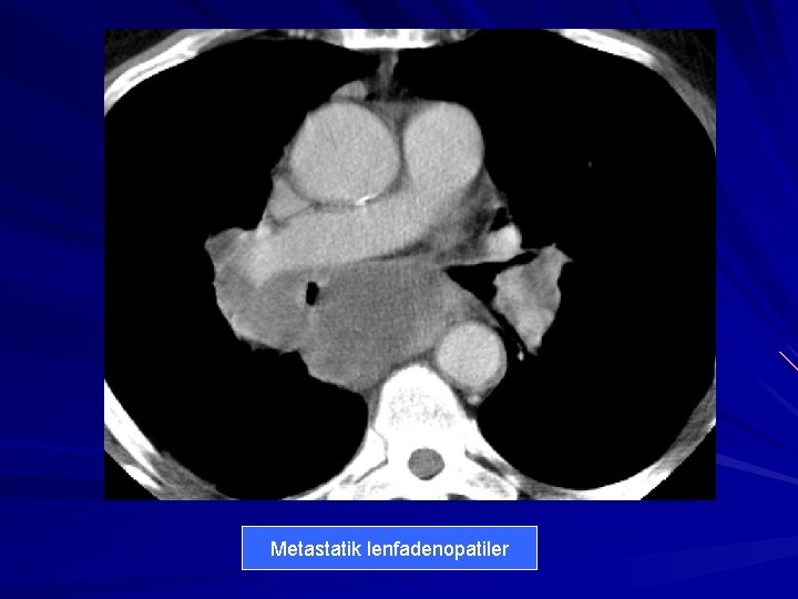 Metastatik lenfadenopatiler 