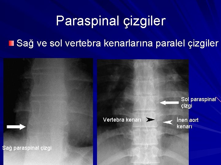 Paraspinal çizgiler Sağ ve sol vertebra kenarlarına paralel çizgiler Sol paraspinal çizgi Vertebra kenarı