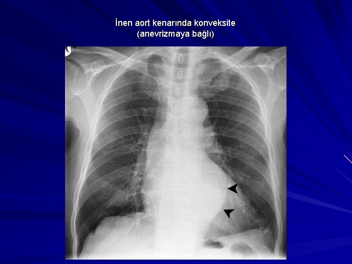 İnen aort kenarında konveksite (anevrizmaya bağlı) 