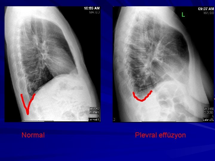 Normal Plevral effüzyon 