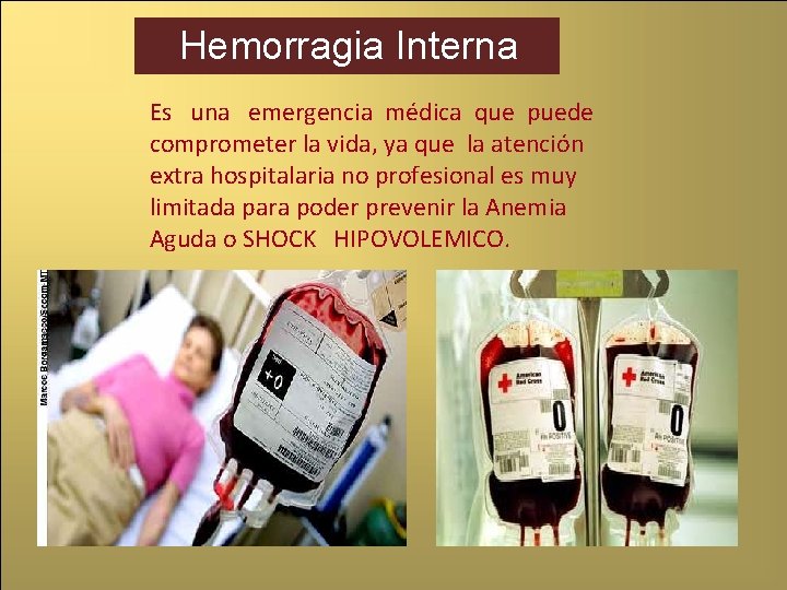 Hemorragia Interna Es una emergencia médica que puede comprometer la vida, ya que la