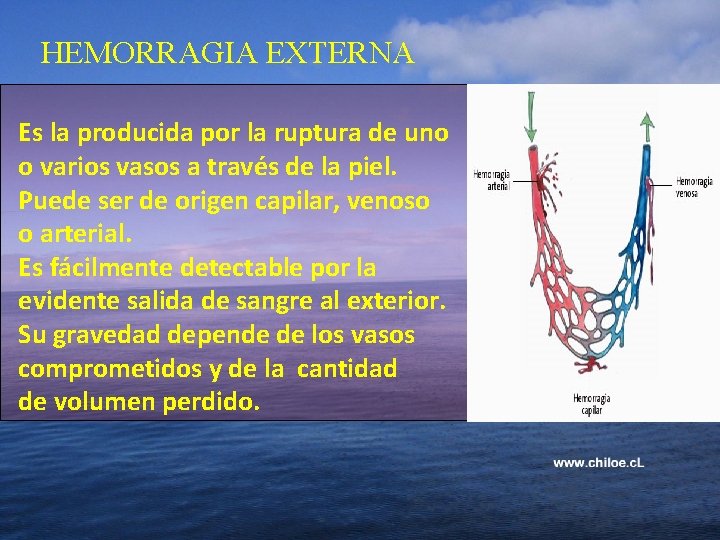 HEMORRAGIA EXTERNA Es la producida por la ruptura de uno o varios vasos a