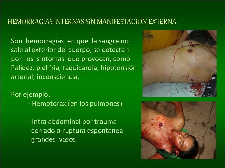 HEMORRAGIAS INTERNAS SIN MANIFESTACION EXTERNA Son hemorragias en que la sangre no sale al