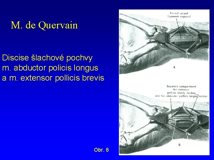 M. de Quervain Discise šlachové pochvy m. abductor policis longus a m. extensor pollicis