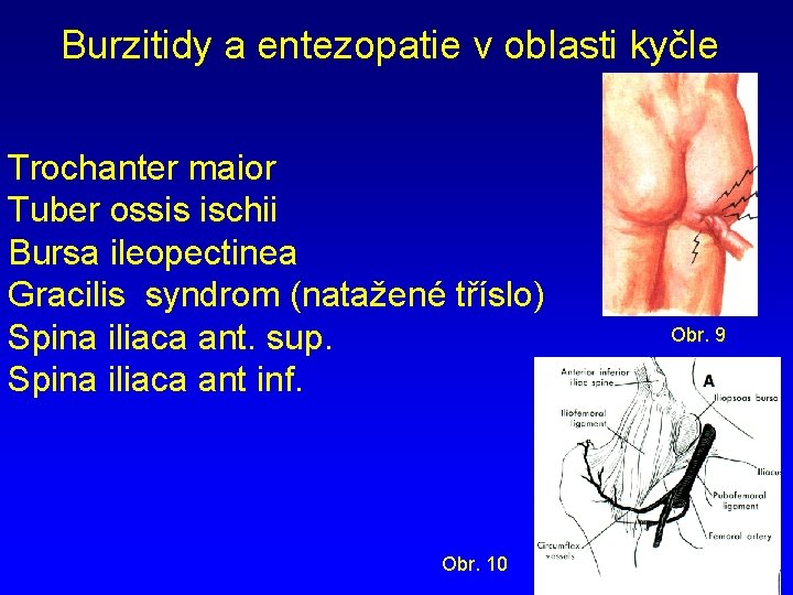 Burzitidy a entezopatie v oblasti kyčle Trochanter maior Tuber ossis ischii Bursa ileopectinea Gracilis