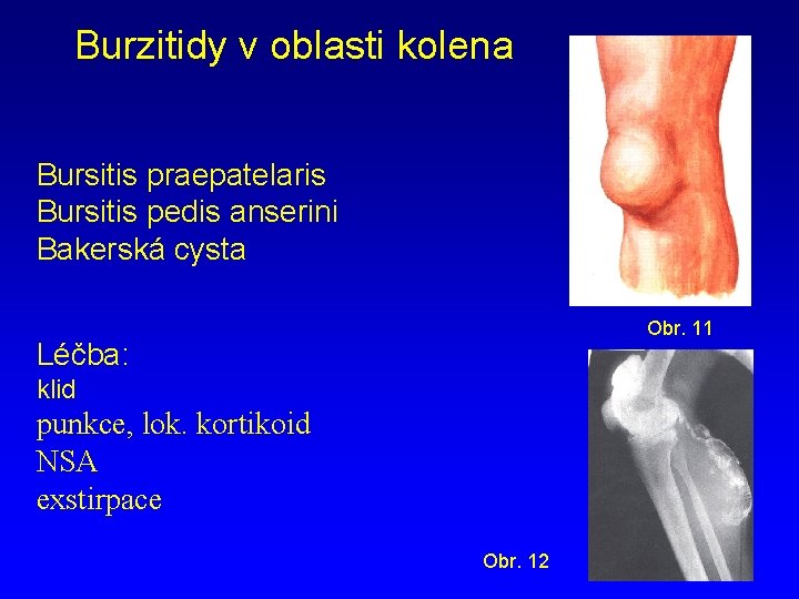 Burzitidy v oblasti kolena Bursitis praepatelaris Bursitis pedis anserini Bakerská cysta Obr. 11 Léčba: