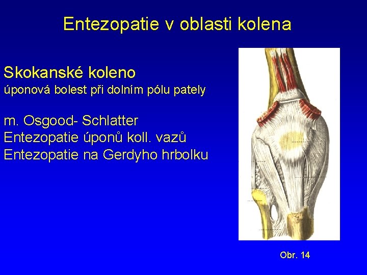 Entezopatie v oblasti kolena Skokanské koleno úponová bolest při dolním pólu pately m. Osgood-