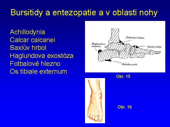 Bursitidy a entezopatie a v oblasti nohy Achillodynia Calcar calcanei Saxlův hrbol Haglundova exostóza