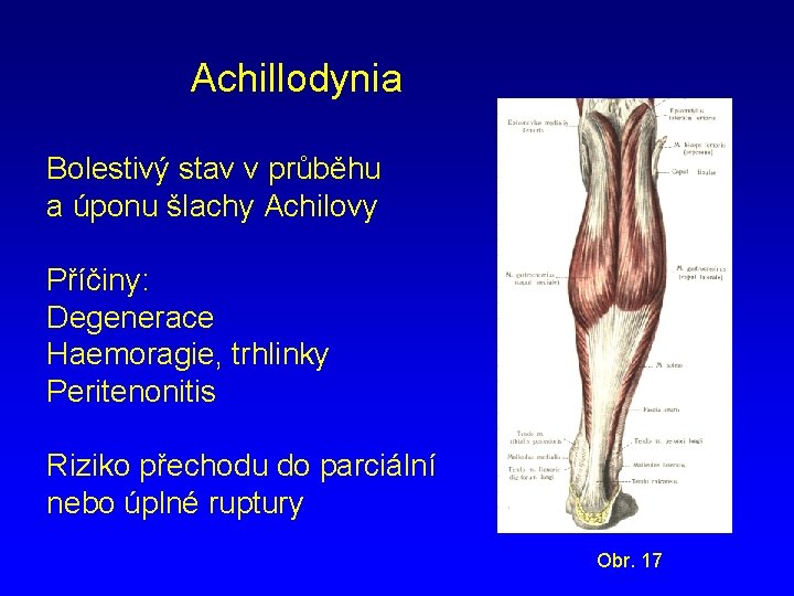 Achillodynia Bolestivý stav v průběhu a úponu šlachy Achilovy Příčiny: Degenerace Haemoragie, trhlinky Peritenonitis