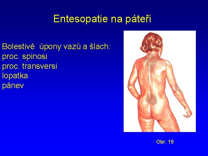 Entesopatie na páteři Bolestivé úpony vazů a šlach: proc. spinosi proc. transversi lopatka pánev
