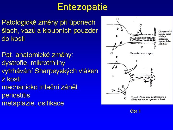 Entezopatie Patologické změny při úponech šlach, vazů a kloubních pouzder do kosti Pat. anatomické