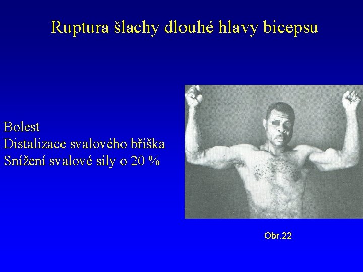Ruptura šlachy dlouhé hlavy bicepsu Bolest Distalizace svalového bříška Snížení svalové síly o 20