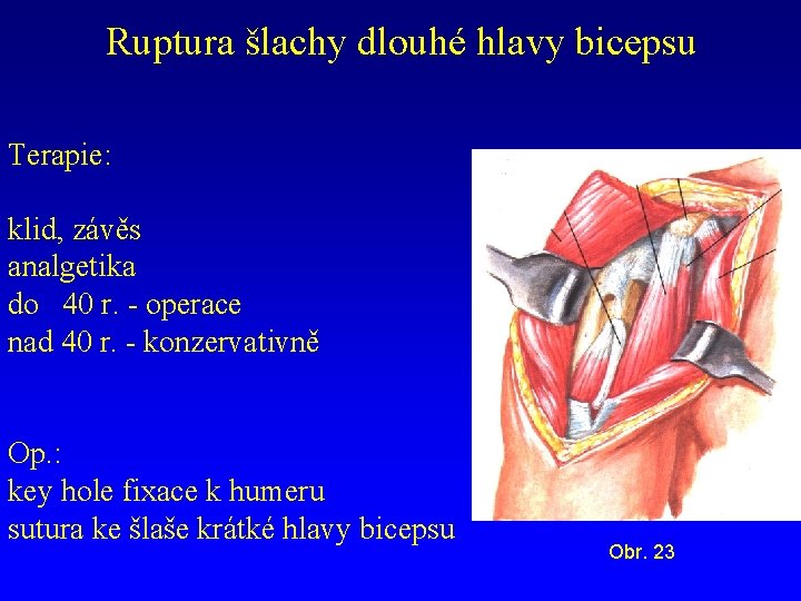 Ruptura šlachy dlouhé hlavy bicepsu Terapie: klid, závěs analgetika do 40 r. - operace