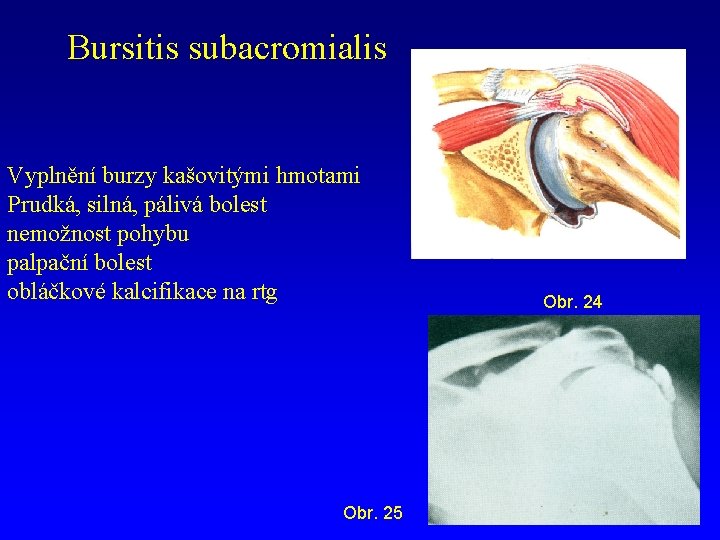 Bursitis subacromialis Vyplnění burzy kašovitými hmotami Prudká, silná, pálivá bolest nemožnost pohybu palpační bolest