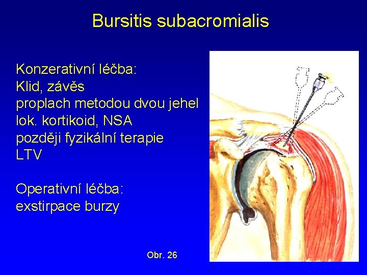 Bursitis subacromialis Konzerativní léčba: Klid, závěs proplach metodou dvou jehel lok. kortikoid, NSA později