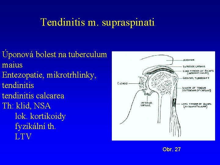 Tendinitis m. supraspinati Úponová bolest na tuberculum maius Entezopatie, mikrotrhlinky, tendinitis calcarea Th: klid,