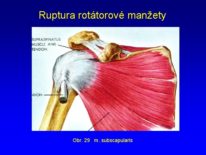 Ruptura rotátorové manžety Obr. 29 m. subscapularis 