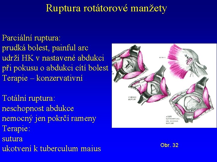 Ruptura rotátorové manžety Parciální ruptura: prudká bolest, painful arc udrží HK v nastavené abdukci
