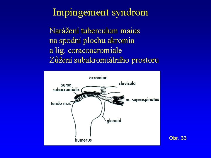 Impingement syndrom Narážení tuberculum maius na spodní plochu akromia a lig. coracoacromiale Zůžení subakromiálního