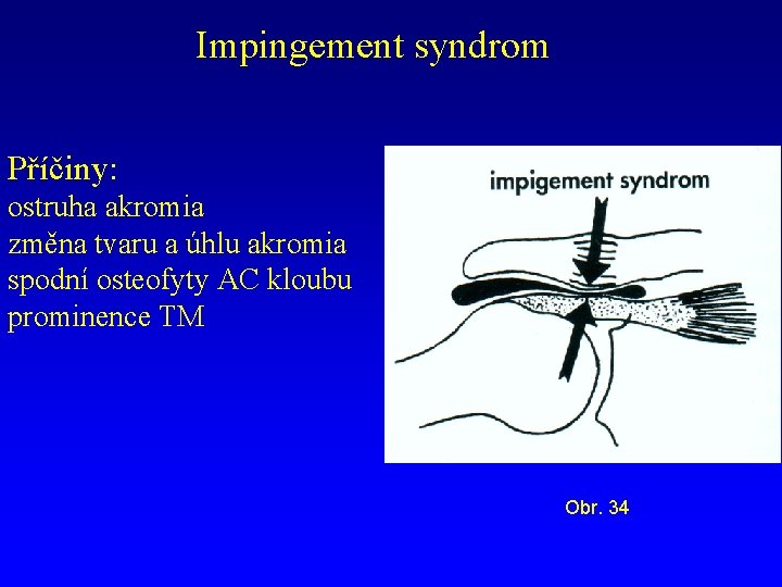Impingement syndrom Příčiny: ostruha akromia změna tvaru a úhlu akromia spodní osteofyty AC kloubu