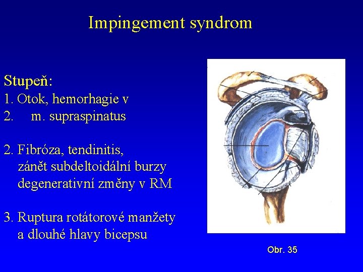 Impingement syndrom Stupeň: 1. Otok, hemorhagie v 2. m. supraspinatus 2. Fibróza, tendinitis, zánět