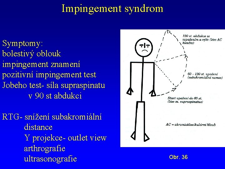 Impingement syndrom Symptomy: bolestivý oblouk impingement znamení pozitivní impingement test Jobeho test- síla supraspinatu