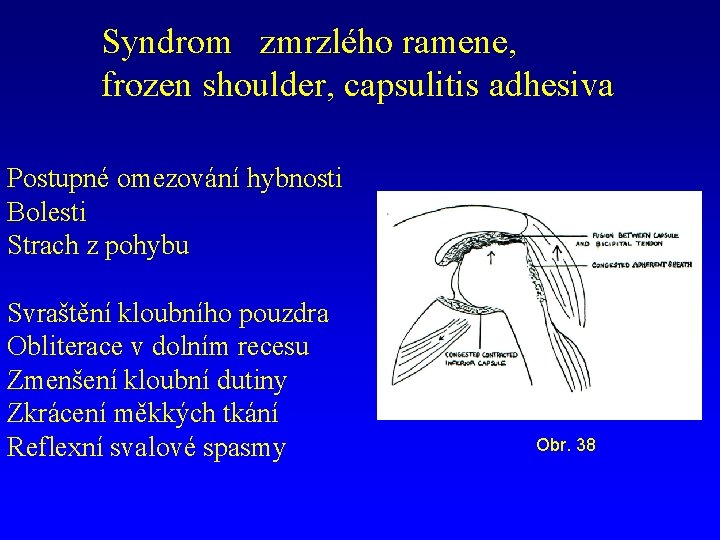 Syndrom zmrzlého ramene, frozen shoulder, capsulitis adhesiva Postupné omezování hybnosti Bolesti Strach z pohybu