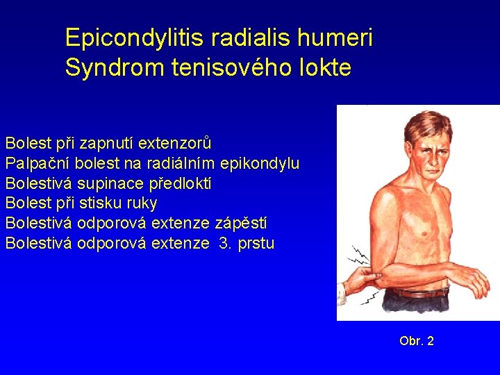 Epicondylitis radialis humeri Syndrom tenisového lokte Bolest při zapnutí extenzorů Palpační bolest na radiálním