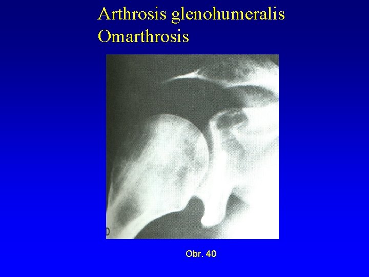 Arthrosis glenohumeralis Omarthrosis Obr. 40 