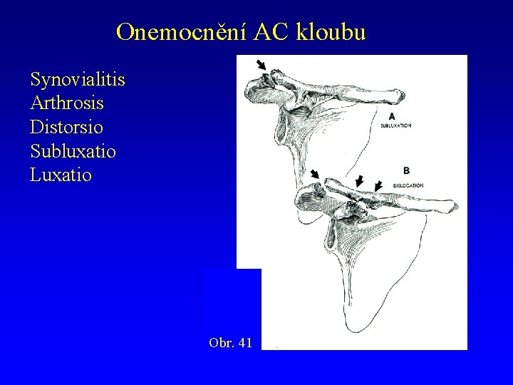 Onemocnění AC kloubu Synovialitis Arthrosis Distorsio Subluxatio Luxatio Obr. 41 