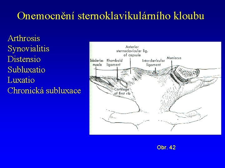 Onemocnění sternoklavikulárního kloubu Arthrosis Synovialitis Distensio Subluxatio Luxatio Chronická subluxace Obr. 42 