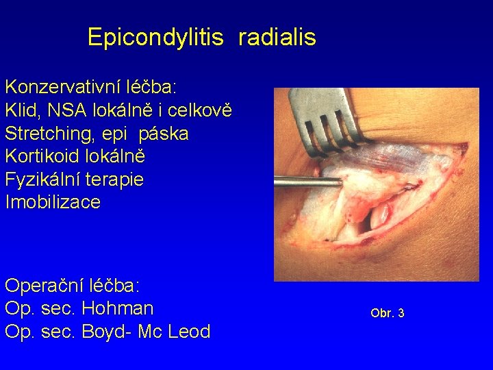 Epicondylitis radialis Konzervativní léčba: Klid, NSA lokálně i celkově Stretching, epi páska Kortikoid lokálně