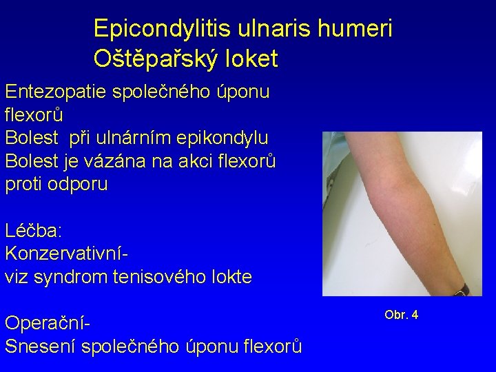 Epicondylitis ulnaris humeri Oštěpařský loket Entezopatie společného úponu flexorů Bolest při ulnárním epikondylu Bolest