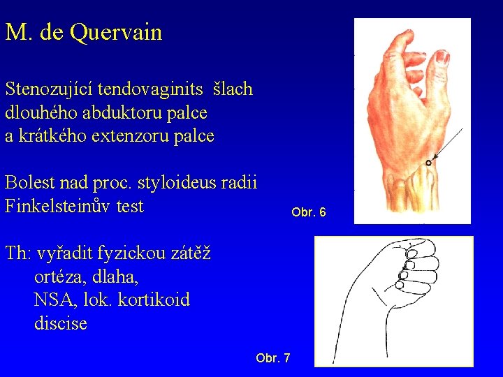 M. de Quervain Stenozující tendovaginits šlach dlouhého abduktoru palce a krátkého extenzoru palce Bolest