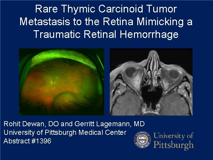 Rare Thymic Carcinoid Tumor Metastasis to the Retina Mimicking a Traumatic Retinal Hemorrhage Rohit