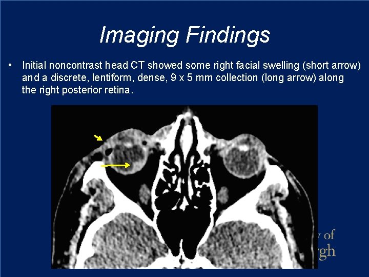 Imaging Findings • Initial noncontrast head CT showed some right facial swelling (short arrow)