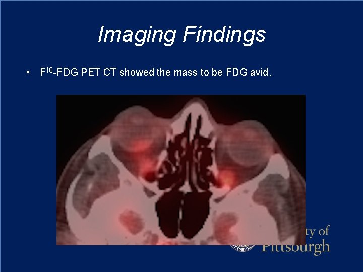 Imaging Findings • F 18 -FDG PET CT showed the mass to be FDG