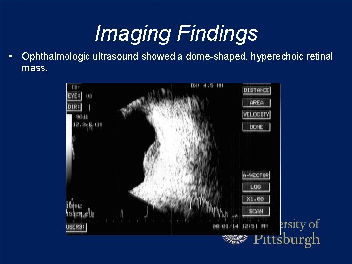 Imaging Findings • Ophthalmologic ultrasound showed a dome-shaped, hyperechoic retinal mass. 