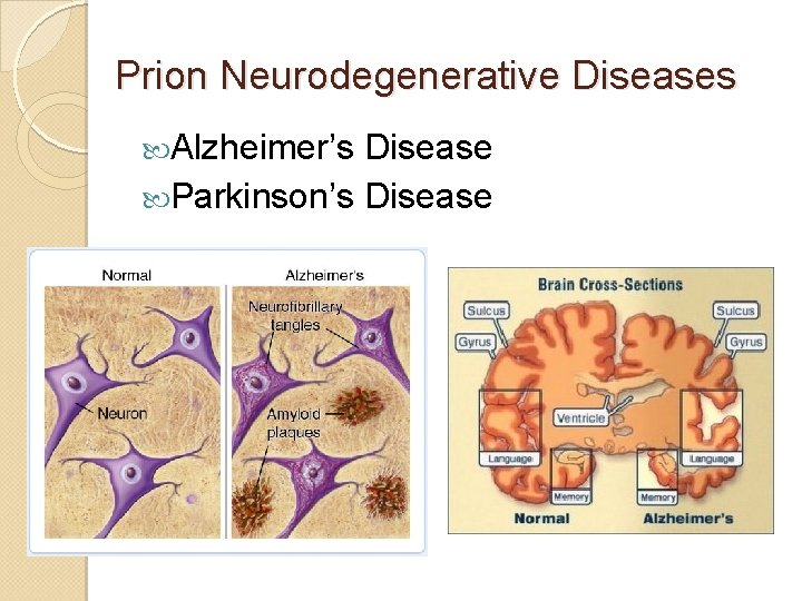 Prion Neurodegenerative Diseases Alzheimer’s Disease Parkinson’s Disease 