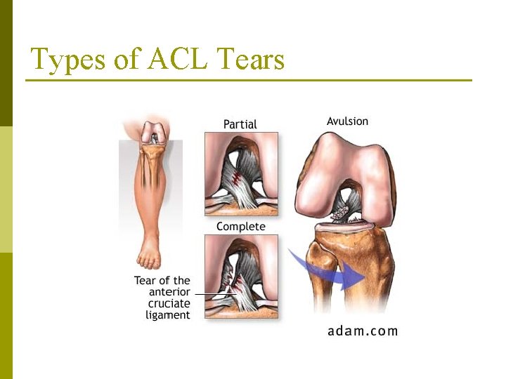 Types of ACL Tears 