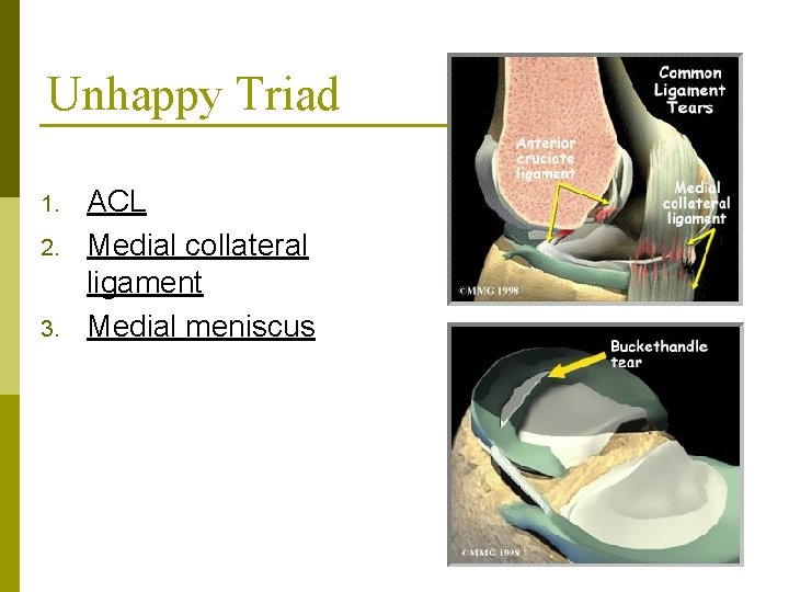 Unhappy Triad 1. 2. 3. ACL Medial collateral ligament Medial meniscus 