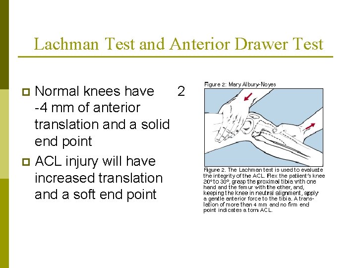 Lachman Test and Anterior Drawer Test Normal knees have 2 -4 mm of anterior