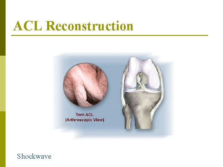 ACL Reconstruction Shockwave 