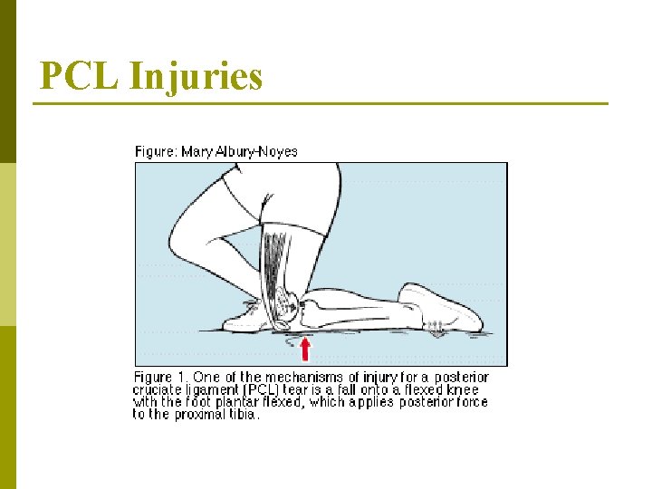 PCL Injuries 