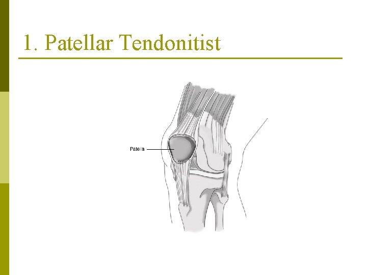 1. Patellar Tendonitist 