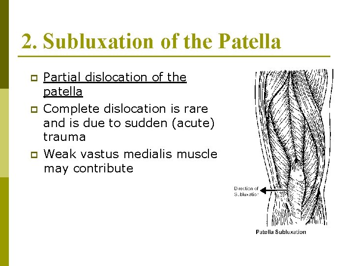 2. Subluxation of the Patella p p p Partial dislocation of the patella Complete