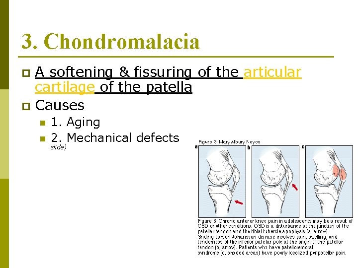 3. Chondromalacia A softening & fissuring of the articular cartilage of the patella p