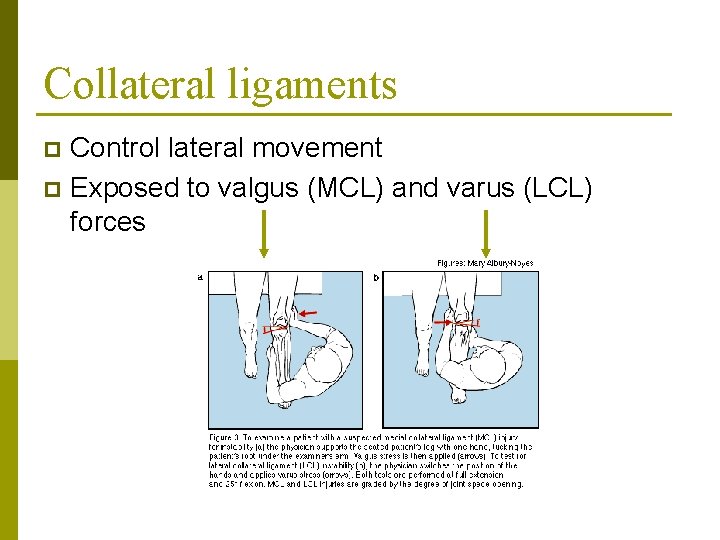 Collateral ligaments Control lateral movement p Exposed to valgus (MCL) and varus (LCL) forces