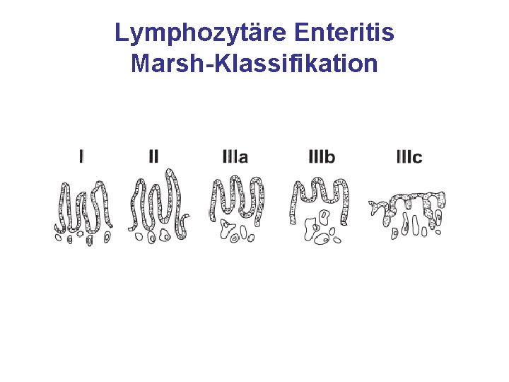 Lymphozytäre Enteritis Marsh-Klassifikation 